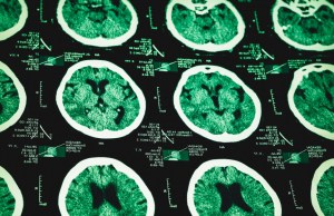 Traumatic Brain Injury