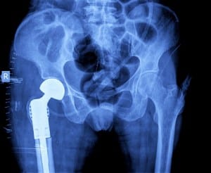 Jury Awards $502 Million Verdict in J&J Defective Hip Implant Lawsuit