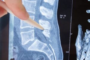 New Study Reveals Many Veterans Are Suffering Spinal Surgery Errors