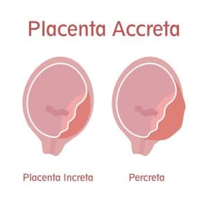 What You Should Know About Placenta Accreta