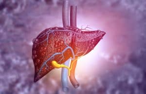 What is Metabolic Dysfunction-Associated Steatotic Liver Disease (MASLD)?