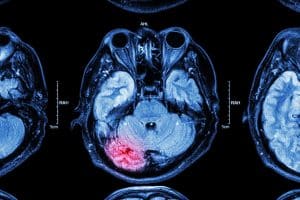 Long-Term Effects of Personal Injuries: Can You Seek Additional Compensation?